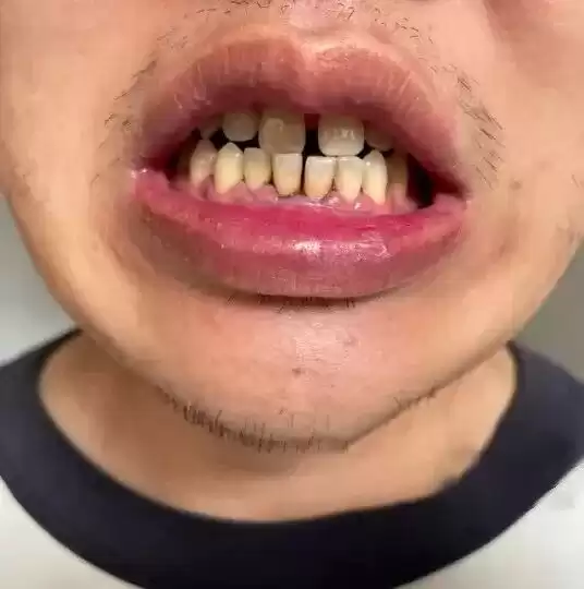 科技守护笑容革命：国家大奖助力牙齿重获新生！