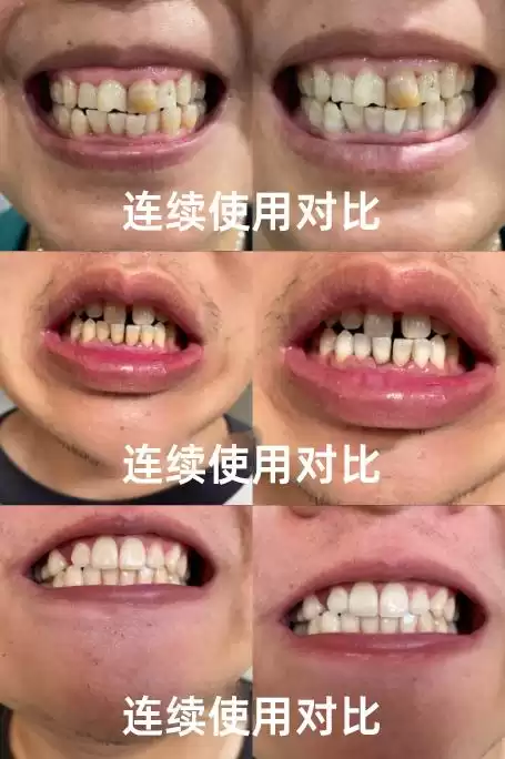 科技守护笑容革命：国家大奖助力牙齿重获新生！