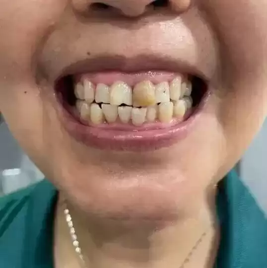 科技守护笑容革命：国家大奖助力牙齿重获新生！