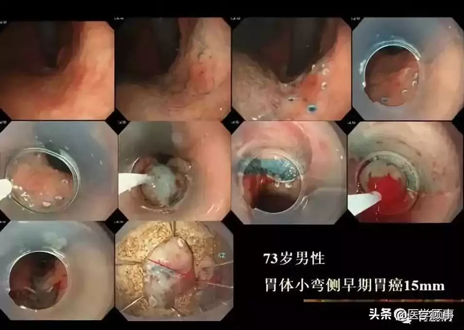 内镜黏膜下剥离术（ESD）：微创革命，根除早癌，保住器官！