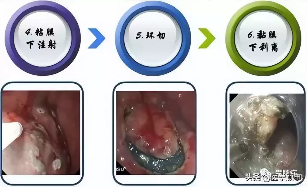 内镜黏膜下剥离术（ESD）：微创革命，根除早癌，保住器官！