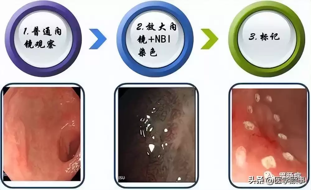 内镜黏膜下剥离术（ESD）：微创革命，根除早癌，保住器官！