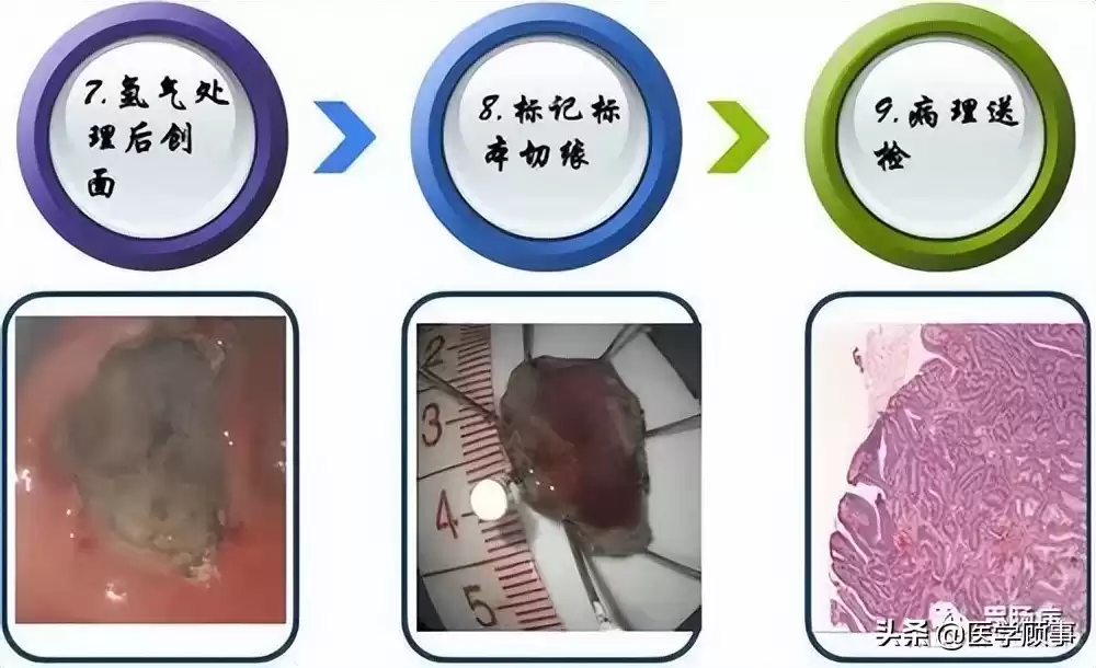 内镜黏膜下剥离术（ESD）：微创革命，根除早癌，保住器官！