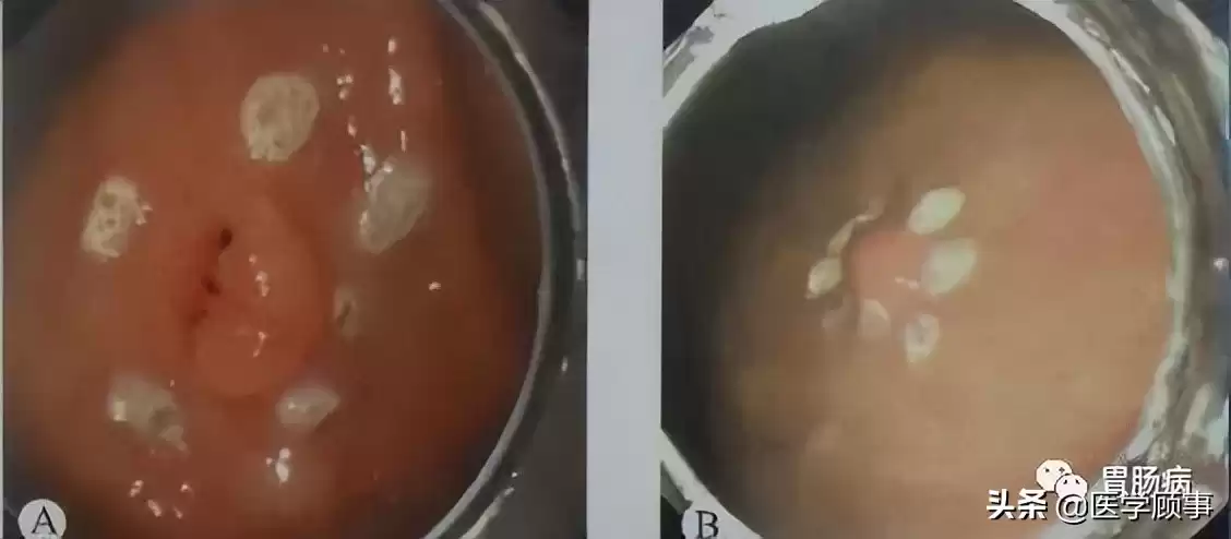 内镜黏膜下剥离术（ESD）：微创革命，根除早癌，保住器官！