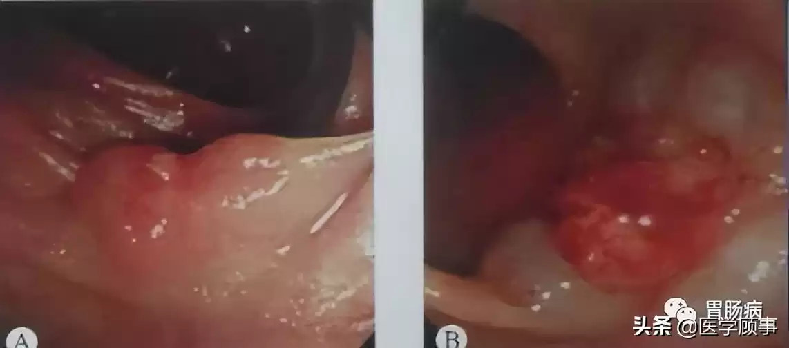 内镜黏膜下剥离术（ESD）：微创革命，根除早癌，保住器官！