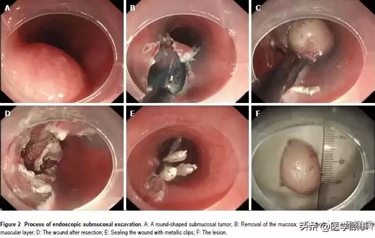 内镜黏膜下剥离术（ESD）：微创革命，根除早癌，保住器官！