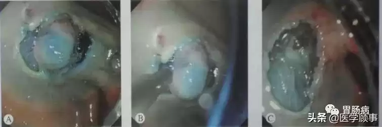 内镜黏膜下剥离术（ESD）：微创革命，根除早癌，保住器官！