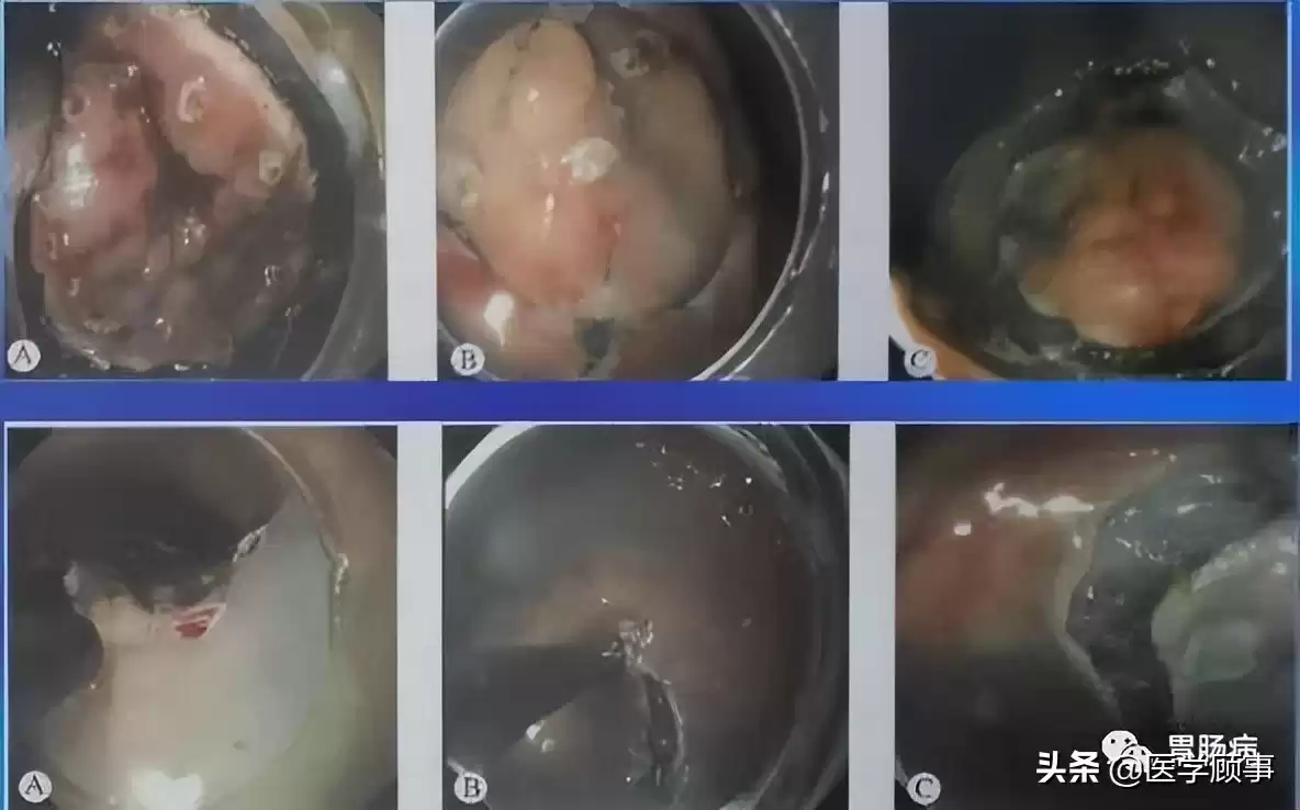 内镜黏膜下剥离术（ESD）：微创革命，根除早癌，保住器官！