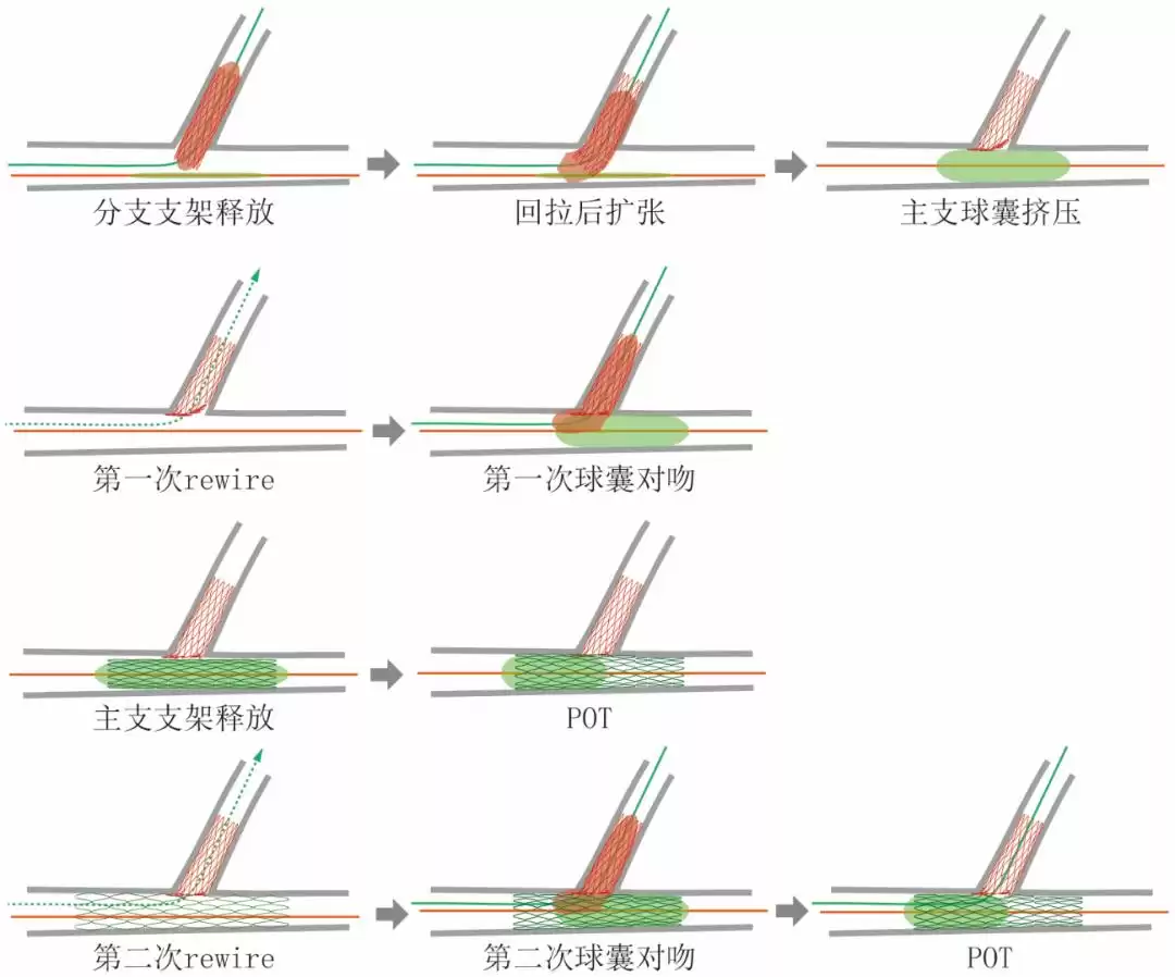 攻克分叉病变核心难题：DK-mini-Crush技术八大操作秘籍