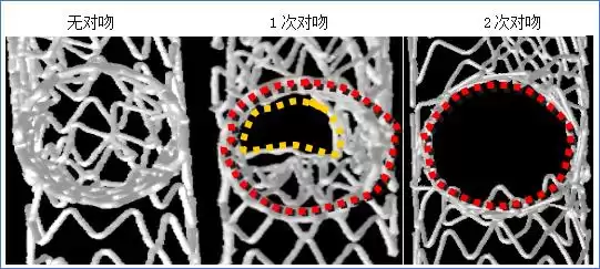 攻克分叉病变核心难题：DK-mini-Crush技术八大操作秘籍