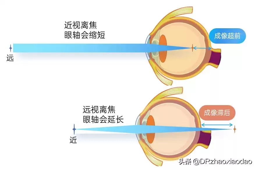 雾视屏&雾视镜终极：逆转近视黑科技，一篇看懂所有！