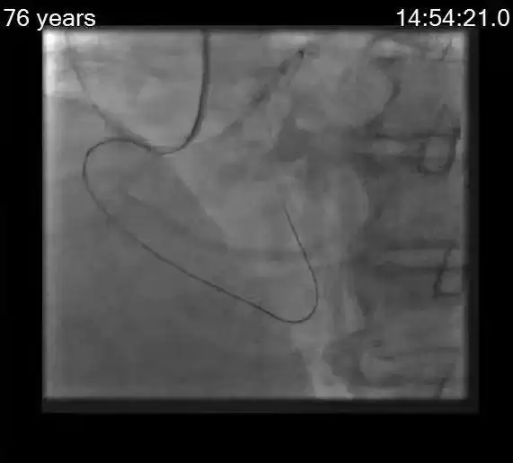 逆流而上，巧破“心”关！华美院区心内科逆向技术成功攻克高危冠脉CTO