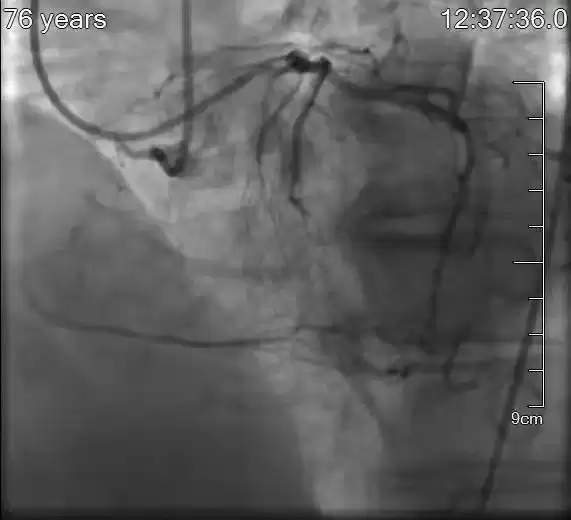 逆流而上，巧破“心”关！华美院区心内科逆向技术成功攻克高危冠脉CTO
