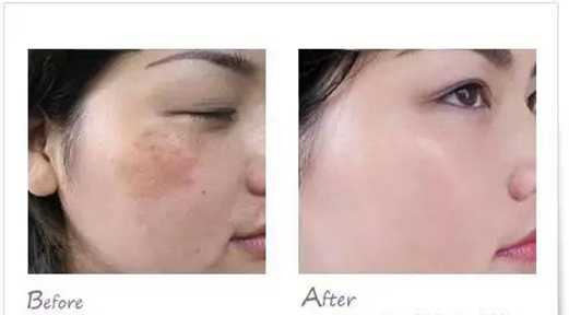 探秘神话美颜技术祛斑：告别斑点的奇妙旅程-第1张图片-正海烽科技 - 领先的只能推广行业，智能制造解决方案提供商