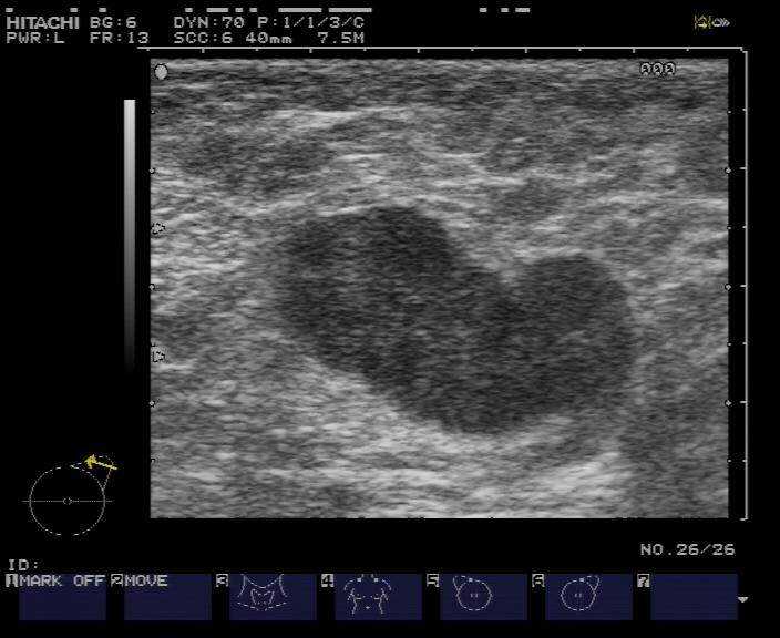 智能医疗新篇：乳腺超声AI病例库，如何从零散报告到精准决策？