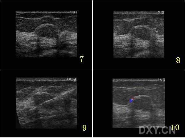 智能医疗新篇：乳腺超声AI病例库，如何从零散报告到精准决策？