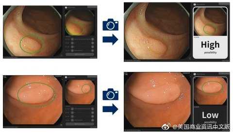 智能硅胶直肠整理新篇章：舒适护理的革命