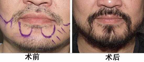 深圳胡须种植tddp技术