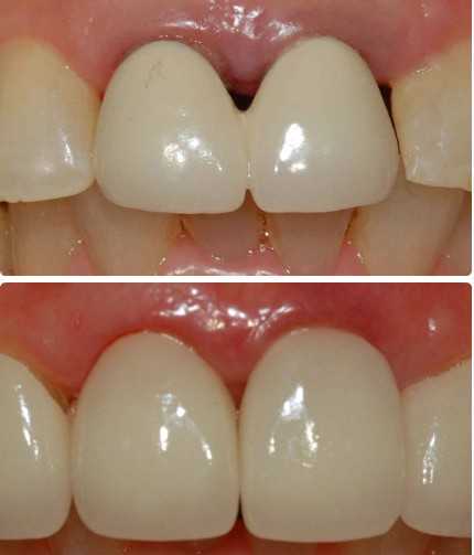 让牙冠“长”得跟真牙一样：从手工雕琢到智能设计的奇妙之旅