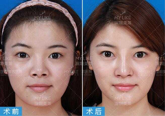 重塑你的面部中轴线：详解当代最先进的鼻整形技术，告别“网红假鼻”时代