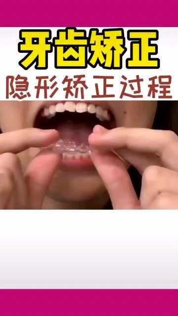 隐形矫正里的蛙跳技术，到底是个啥神奇操作？