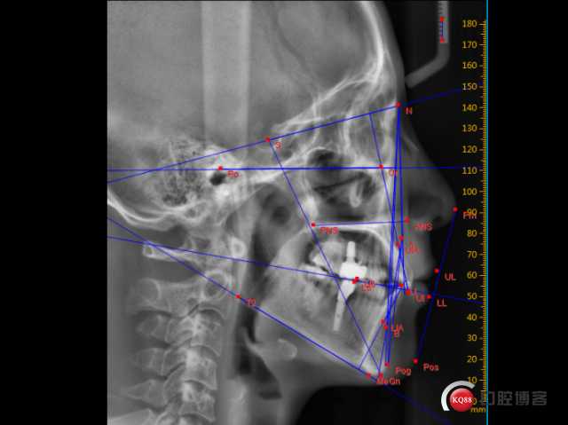 隐形矫正里的蛙跳技术，到底是个啥神奇操作？