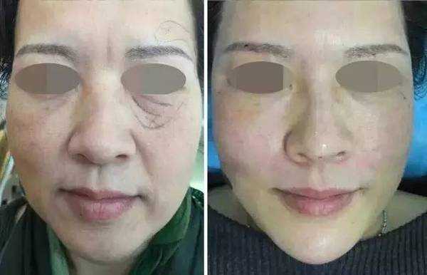 面部线技术：悄悄变年轻的现代魔法