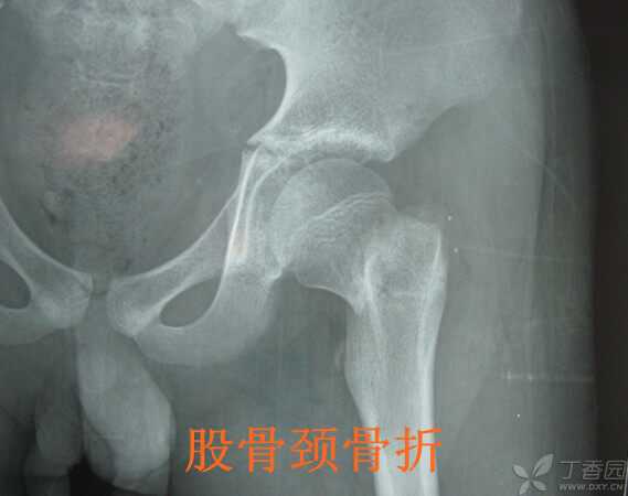 骨伤修复遇瓶颈？新技术让“贴片”变“智能修复工”