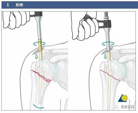 骨科间歇充气压缩技术到底是啥？俺给你唠明白！