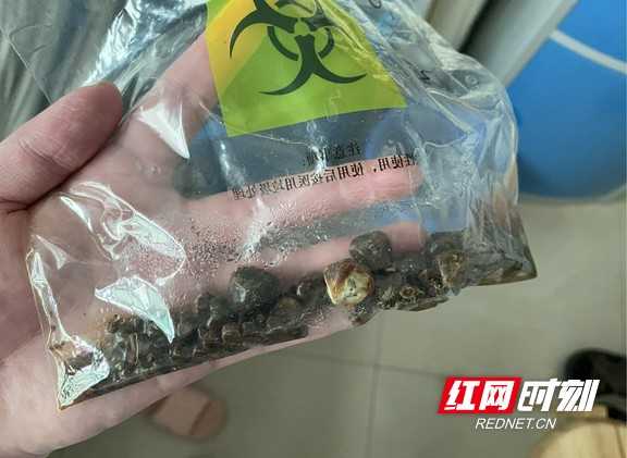 保胆取石技术：留住胆囊的新选择
