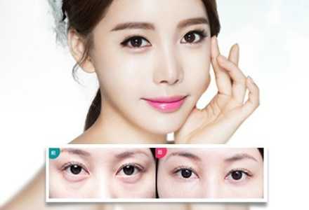 告别显老眼袋，这些不开刀的新技术让你重拾青春眼神-第2张图片-正海烽科技 - 领先的只能推广行业，智能制造解决方案提供商