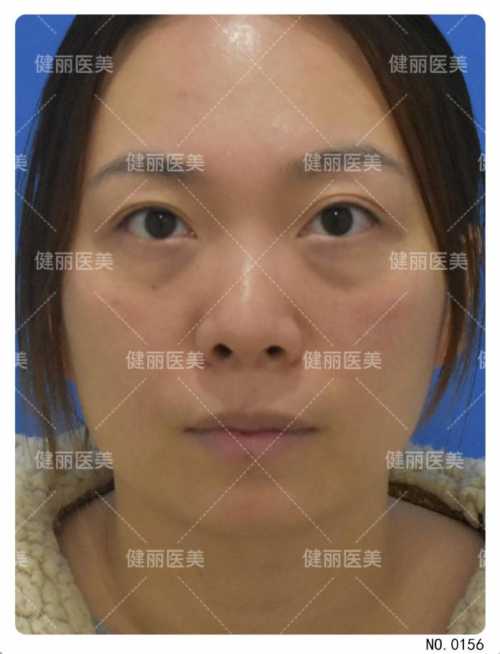 告别显老眼袋，这些不开刀的新技术让你重拾青春眼神-第1张图片-正海烽科技 - 领先的只能推广行业，智能制造解决方案提供商