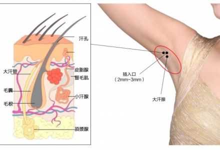 夏日无“味”大作战，注射除腋臭技术全攻略