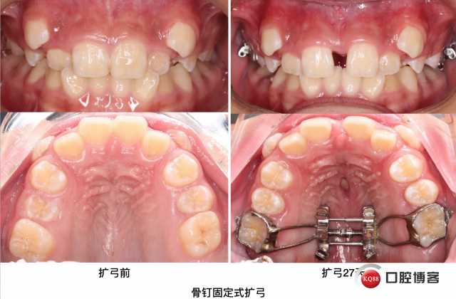 多曲方丝弓，那个被叫做“妙”技术的正畸利器-第1张图片-正海烽科技 - 领先的只能推广行业，智能制造解决方案提供商
