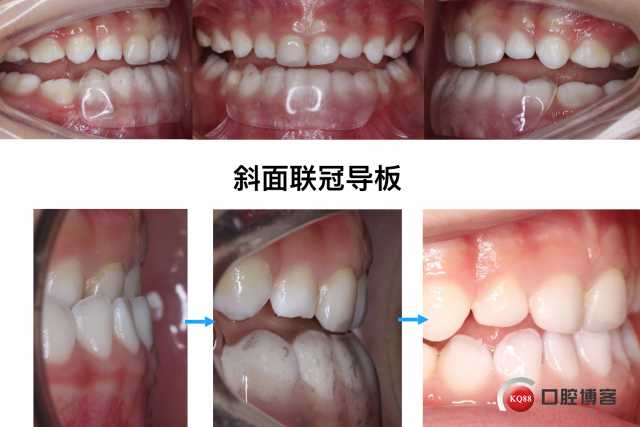 多曲方丝弓，那个被叫做“妙”技术的正畸利器-第2张图片-正海烽科技 - 领先的只能推广行业，智能制造解决方案提供商