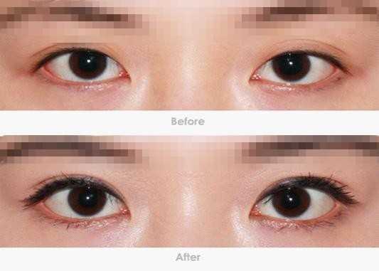 开眼角这事儿，真不是一刀切的技术活